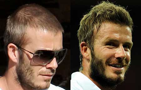 Injerto de pelo en David Beckham